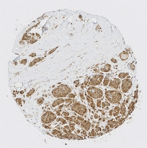 Click to enlarge image Tissue Micro-Array (TMA) core of breast cancer  showing cytoplasmic and nuclear staining using Antibody CPTC-YAP1-1. Titer: 1:5000