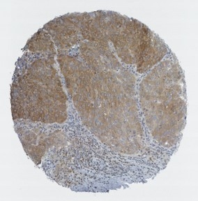 Click to enlarge image Tissue Microarray core of lung cancer immunohistochemically stained with antibody CPTC-GSK3B-10