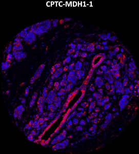 Click to enlarge image Imaging mass cytometry on breast cancer tissue core using CPTC-MBD1-1 metal-labeled antibody.  Data shows an overlay of the target protein signal (red) and DNA (blue). Dilution: 1:100 of 0.5mg/mL stock. Signal was also obtained in other normal tissues (liver, bone marrow, spleen, prostate, colon, pancreas, breast, lung, testis, endometrium, and appendix) and cancer tissues (breast, prostate, colon, ovarian, and lung).