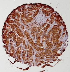 Click to enlarge image Tissue Micro-Array(TMA) core of breast cancer showing cytoplasmic staining using Antibody CPTC-Ezrin-1. Titer: 1:4000