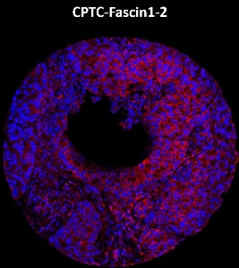 Click to enlarge image Imaging mass cytometry on lung cancer tissue core using CPTC-Fascin1-2 metal-labeled antibody.  Data shows an overlay of the target protein signal (red) and DNA (blue). Dilution: 1:100 of 0.5mg/mL stock.  Signal was also obtained in other normal tissues (testis, prostate, liver, colon, endometrium, appendix, pancreas, bone marrow, breast, kidney, lung, and placenta) and cancer tissues (breast, lung, prostate, colon and ovarian).