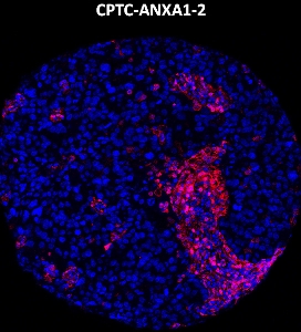 Click to enlarge image Imaging mass cytometry on lung cancer tissue core using CPTC-ANXA1-2 metal-labeled antibody.  Data shows an overlay of the target protein signal (red) and DNA (blue). Dilution: 1:100 of 0.5mg/mL stock. Signal was also obtained in other normal tissues (liver, bone marrow, spleen, prostate, colon, pancreas, breast, lung, testis, endometrium, appendix, and kidney) and cancer tissues (breast, lung, prostate, colon, and ovarian).