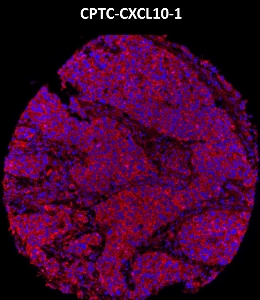 Click to enlarge image Imaging mass cytometry on breast cancer tissue core using CPTC-CXCL10-1 metal-labeled antibody.  Data shows overlay of target protein signal (red) and DNA (blue). Dilution: 1:100 of 0.5mg/mL stock. Signal was also obtained in other normal tissues (testis, prostate, liver, colon, endometrium, appendix, pancreas, bone marrow, breast, kidney, lung, and placenta) and cancer tissues (breast, colon, prostate, lung, and ovarian).