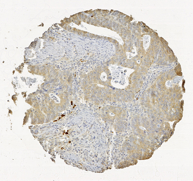 Click to enlarge image Tissue Micro-Array(TMA) core of colon cancer showing cytoplasmic staining using Antibody CPTC-IDO1-2. Titer: 1:8000