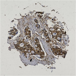 Click to enlarge image Tissue Micro-Array(TMA) core of colon cancer  showing cytoplasmic staining using Antibody CPTC-PSMD4-3. Titer: 1:500