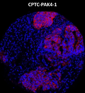 Click to enlarge image Imaging mass cytometry on ovarian cancer tissue core using CPTC-PAK4-1 metal-labeled antibody.  Data shows overlay of target protein signal (red) and DNA (blue). Dilution: 1:100 of 0.5mg/mL stock. Signals were also obtained in other normal tissues (testis, prostate, liver, colon, endometrium, appendix, pancreas, bone marrow, breast, and kidney) and cancer tissues (breast, colon, prostate, lung, and ovarian).
