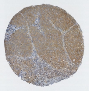 Click to enlarge image Tissue Microarray core of lung cancer immunohistochemically stained with antibody CPTC-RAF1-3