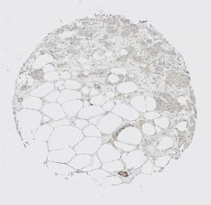 Click to enlarge image Tissue Micro-Array (TMA) core of breast cancer  showing cytoplasmic staining using Antibody CPTC-CRP-1. Titer: 1:1000

The pattern of staining is correct but lacks sufficient literature data to confirm cell type specificity.