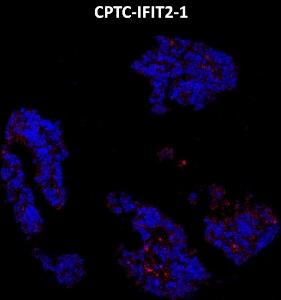 Click to enlarge image Imaging mass cytometry on ovarian cancer tissue core using CPTC-IFIT2-1 metal-labeled antibody.  Data shows overlay of target protein signal (red) and DNA (blue). Dilution: 1:100 of 0.5mg/mL stock. Signal was also obtained in other normal tissue (lung) and cancer tissues (ovarian and prostate).