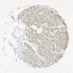 Click to enlarge image Tissue Micro-Array(TMA) core of breast cancer showing cytoplasmic staining using Antibody CPTC-UBE2J1-2. Titer: 1:30000