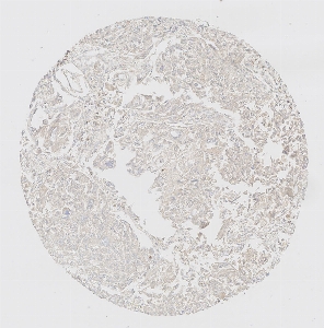 Click to enlarge image Tissue Micro-Array (TMA) core of lung cancer showing cytoplasmic staining using Antibody CPTC-MST1-1. Titer: 1:1000