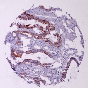 Click to enlarge image Tissue Micro-Array(TMA) core of colon cancer showing cytoplasmic staining using Antibody CPTC-PRDX4-1. Titer: 1:5000