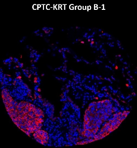 Click to enlarge image Imaging mass cytometry on lung cancer tissue core using CPTC-KRT Group B-1 metal-labeled antibody.  Data shows an overlay of the target protein signal (red) and DNA (blue). Dilution: 1:100 of 0.5mg/mL stock. Signal was also obtained in other normal tissues (liver, appendix, breast, kidney, lung and placenta) and cancer tissues (breast, colon, prostate, lung, and ovarian).