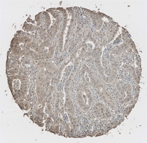 Click to enlarge image Tissue Micro-Array (TMA) core of lung cancer  showing cytoplasmic and nuclear staining using Antibody CPTC-PSMA1-1. Titer: 1:40000