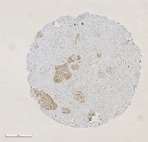 Click to enlarge image Tissue Micro-Array(TMA) core of pancreatic cancer showing nuclear staining using Antibody CPTC-MKi67-4. Titer: 1:1250