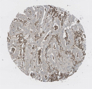 Click to enlarge image Tissue Micro-Array (TMA) core of lung cancer  showing cytoplasmic and membranous staining using Antibody CPTC-CD33-1. Titer: 1:250