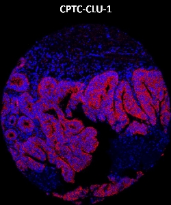 Click to enlarge image Imaging mass cytometry on colon cancer tissue core using CPTC-CLU-1 metal-labeled antibody.  Data shows an overlay of the target protein signal (red) and DNA (blue). Dilution: 1:100 of 0.5mg/mL stock. Signal was also obtained in other normal tissues (testis, prostate, liver, colon, endometrium, appendix, pancreas, bone marrow, breast, kidney, lung, and placenta) and cancer tissues (breast, colon, prostate, lung, and ovarian).