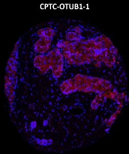Click to enlarge image Imaging mass cytometry on breast cancer tissue core using CPTC-OTUB1-1 metal-labeled antibody.  Data shows an overlay of the target protein signal (red) and DNA (blue). Dilution: 1:100 of 0.5mg/mL stock. Signal was also obtained in other normal tissues (prostate, liver, colon, appendix, pancreas, bone marrow, breast, kidney, lung, and placenta) and cancer tissues (breast, colon, prostate, lung, and ovarian).