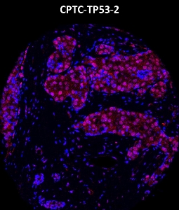 Click to enlarge image Imaging mass cytometry on breast cancer tissue core using CPTC-TP53-2 metal-labeled antibody.  Data shows overlay of target protein signal (red) and DNA (blue). Dilution: 1:100 of 0.5mg/mL stock. Signal was also obtained in other normal tissues (testis, prostate, liver, colon, endometrium, appendix, pancreas, bone marrow, breast, kidney, lung, and placenta) and cancer tissues (breast, colon, prostate, lung, and ovarian).