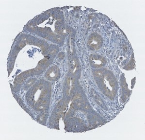 Click to enlarge image Tissue Microarray core of colon cancer showing immunohistochemical staining for Antibody CPTC-BRAF-6.