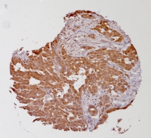Click to enlarge image Tissue Micro-Array(TMA) core of ovarian cancer showing cytoplasmic staining using Antibody CPTC-CLIC1-2. Titer: 1:250