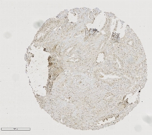 Click to enlarge image Tissue Micro-Array(TMA) core of pancreatic cancer showing nuclear staining using Antibody CPTC-LMNB1-1. Titer: 1:50