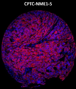 Click to enlarge image Imaging mass cytometry on ovarian cancer tissue core using CPTC-NME1-5 metal-labeled antibody.  Data shows an overlay of the target protein signal (red) and DNA (blue). Dilution: 1:100 of 0.5mg/mL stock. Signal was also obtained in other normal tissues (testis, prostate, liver, colon, endometrium, appendix, pancreas, bone marrow, breast, kidney, lung, and placenta) and cancer tissues (breast, lung, prostate, colon and ovarian).