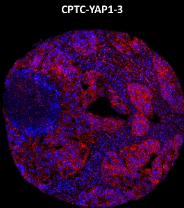 Click to enlarge image Imaging mass cytometry on ovarian cancer tissue core using CPTC-YAP1-3 metal-labeled antibody.  Data shows overlay of target protein signal (red) and DNA (blue). Dilution: 1:100 of 0.5mg/mL stock. Signal was also obtained in other cancer tissues (lung and ovarian).