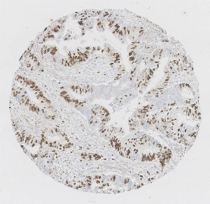Click to enlarge image Tissue Micro-Array (TMA) core of colon cancer  showing nuclear staining using Antibody CPTC-MKI67-1. Titer: 1:500