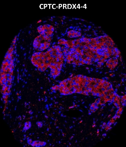 Click to enlarge image Imaging mass cytometry on breast cancer tissue core using CPTC-PRDX4-4 metal-labeled antibody.  Data shows overlay of target protein signal (red) and DNA (blue). Dilution: 1:100 of 0.5mg/mL stock. Signal was also obtained in other normal tissues (liver, colon, endometrium, pancreas, bone marrow, breast, and kidney) and cancer tissues (breast, colon, prostate, lung, and ovarian).