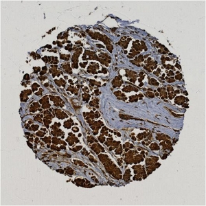 Click to enlarge image Tissue Micro-Array(TMA) core of breast cancer  showing cytoplasmic staining using Antibody CPTC-YWHAE-3. Titer: 1:4000