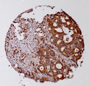 Click to enlarge image Tissue Micro-Array(TMA) core of colon cancer showing cytoplasmic staining using Antibody CPTC-GCLM-2. Titer: 1:100