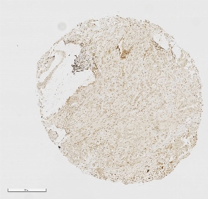 Click to enlarge image Tissue Micro-Array(TMA) core of pancreatic cancer showing nuclear staining using Antibody CPTC-RTF1-1. Titer: 1:6250