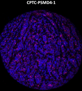 Click to enlarge image Imaging mass cytometry on breast cancer tissue core using CPTC-PSMD4-1 metal-labeled antibody.  Data shows an overlay of the target protein signal (red) and DNA (blue). Dilution: 1:100 of 0.5mg/mL stock. Signal was also obtained in other normal tissues (endometrium and appendix) and cancer tissues (breast, colon, ovarian, lung, and prostate).