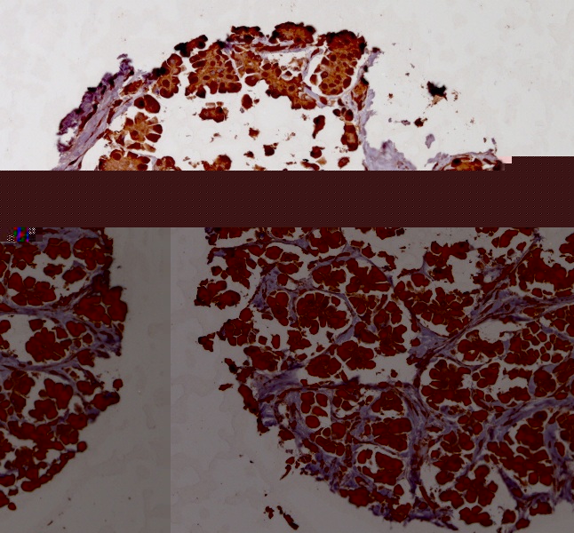 Click to enlarge image Tissue Micro-Array(TMA) core of breast cancer showing cytoplasmic staining using Antibody CPTC-SFN-2 . Titer: 1:100