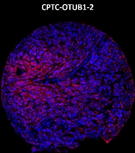 Click to enlarge image Imaging mass cytometry on ovarian cancer tissue core using CPTC-OTUB1-2 metal-labeled antibody.  Data shows an overlay of the target protein signal (red) and DNA (blue). Dilution: 1:100 of 0.5mg/mL stock. Signal was also obtained in other normal tissues (testis, liver, colon, endometrium, breast, kidney, lung, and placenta) and cancer tissues (breast, colon, prostate, lung and ovarian).