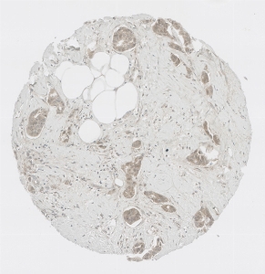 Click to enlarge image Tissue Micro-Array (TMA) core of breast cancer  showing cytoplasmic staining using Antibody CPTC-IL2RG-1. Titer: 1:50
The pattern of staining is correct but lacks sufficient literature data to confirm cell type specificity.