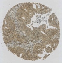 Click to enlarge image IHC of CPTC-AKT3-4 antibody applied to colon cancer.