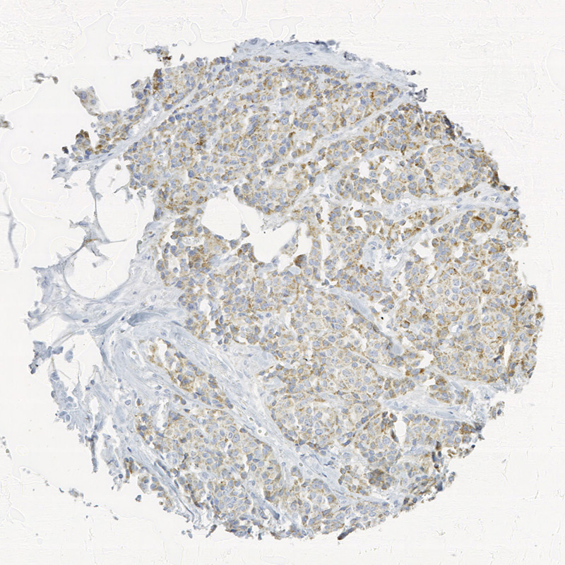 Click to enlarge image Tissue Micro-Array(TMA) core of breast cancer showing cytoplasmic staining using Antibody CPTC-TACSTD2-3. Titer: 1:25000