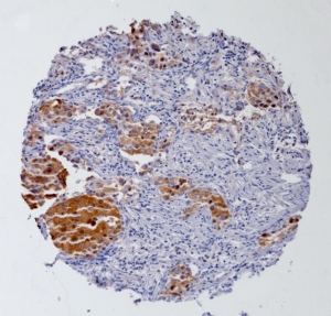 Click to enlarge image Tissue Micro-Array(TMA) core of lung cancer showing cytoplasmic staining using Antibody CPTC-GSTMu1-5. Titer: 1:3000