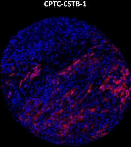 Click to enlarge image Imaging mass cytometry on lung cancer tissue core using CPTC-CSTB-1 metal-labeled antibody.  Data shows an overlay of the target protein signal (red) and DNA (blue). Dilution: 1:100 of 0.5mg/mL stock. Signal was also obtained in other normal tissues (lung, testis, and endometrium) and cancer tissue (lung).