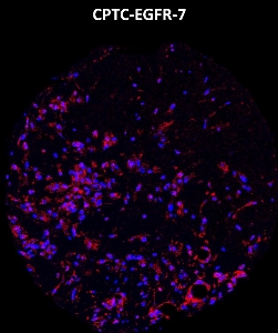 Click to enlarge image Imaging mass cytometry on breast cancer tissue core using CPTC-EGFR-7 metal-labeled antibody.  Data shows overlay of target protein signal (red) and DNA (blue). Dilution: 1:100 of 0.5mg/mL stock. Signal was also obtained in other normal tissues (testis, prostate, liver, colon, endometrium, breast, kidney, lung, and placenta) and cancer tissues (breast and colon).