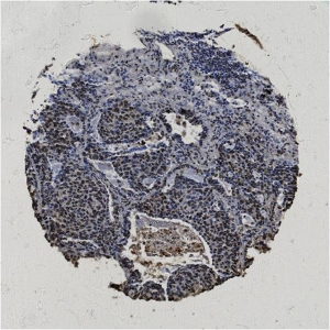 Click to enlarge image Tissue Micro-Array(TMA) core of lung cancer  showing nuclear staining using Antibody CPTC-GMNN-2. Titer: 1:800