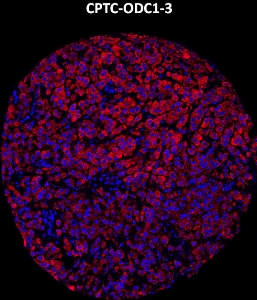 Click to enlarge image Imaging mass cytometry on breast cancer tissue core using CPTC-ODC1-3 metal-labeled antibody.  Data shows an overlay of the target protein signal (red) and DNA (blue). Dilution: 1:100 of 0.5mg/mL stock. Signal was also obtained in other normal tissues (liver, bone marrow, spleen, placenta, prostate, colon, pancreas, breast, lung, endometrium, appendix, and kidney) and cancer tissues (breast, colon, ovarian, lung, and prostate).