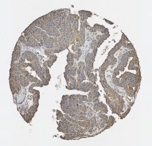 Click to enlarge image Tissue Microarray core of ovarian cancer immunohistochemically stained with CPTC-MTOR-3