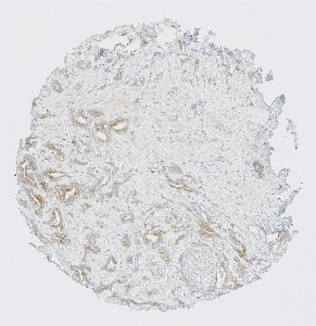Click to enlarge image Tissue Micro-Array (TMA) core of prostate cancer  showing cytoplasmic and membranous staining using Antibody CPTC-MSLN-1. Titer: 1:5000