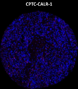 Click to enlarge image Imaging mass cytometry on lung cancer tissue core using CPTC-CALR-1 metal-labeled antibody.  Data shows an overlay of the target protein signal (red) and DNA (blue). Dilution: 1:100 of 0.5mg/mL stock. Signal was also obtained in other normal tissues (prostate, liver, colon, appendix, breast, kidney, lung, and placenta) and cancer tissues (breast, colon, prostate, lung, and ovarian).