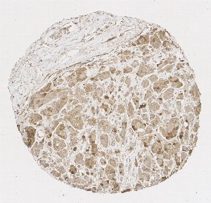 Click to enlarge image Tissue Micro-Array (TMA) core of breast  showing cytoplasmic staining using Antibody CPTC-CRABP2-2. Titer: 1:1000