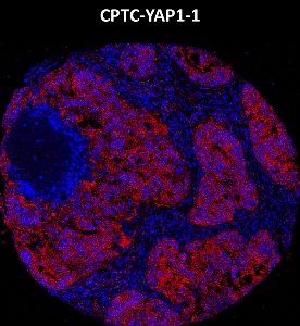 Click to enlarge image Imaging mass cytometry on ovarian cancer tissue core using CPTC-YAP1-1 metal-labeled antibody.  Data shows overlay of target protein signal (red) and DNA (blue). Dilution: 1:100 of 0.5mg/mL stock. Signal was also obtained in other cancer tissues (lung and ovarian).
