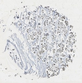 Click to enlarge image Tissue Microarray core of breast cancer immunohistochemically stained with antibody CPTC-RAF1-2